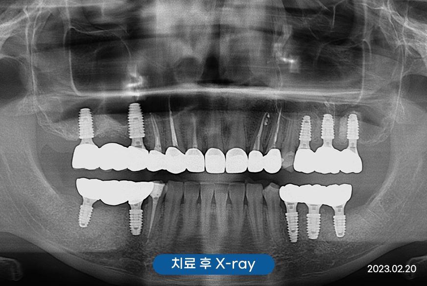 신사역주말치과 갑자기 어금니 이빨 부러졌다면 관련 이미지 8