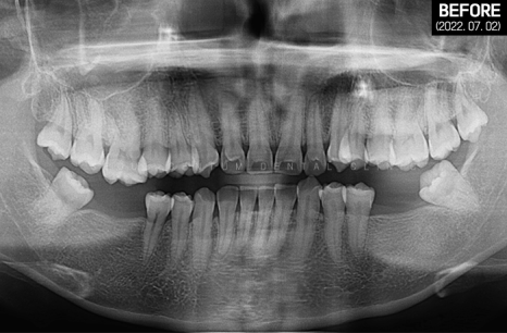 돌출입 및 신경치료와 임플란트 식립 동시 진행 증례 관련 이미지 31