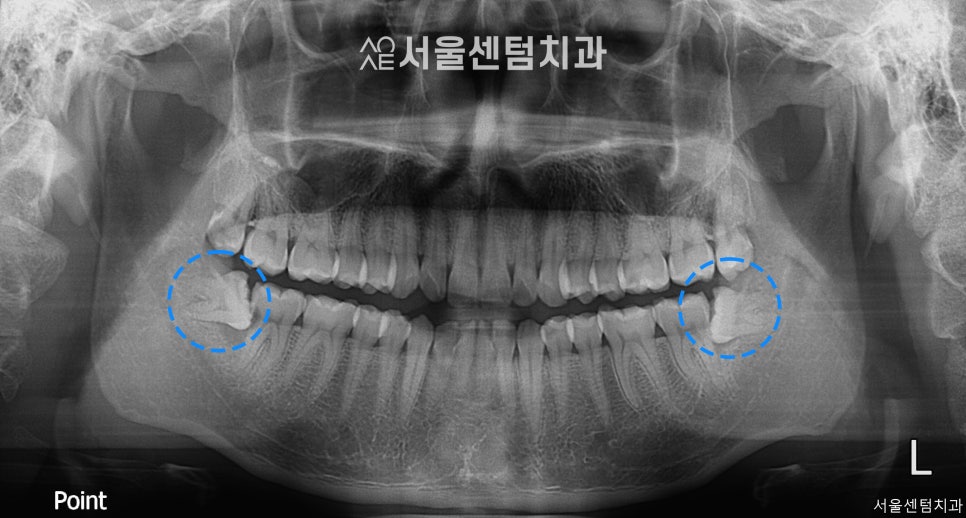 A Successful Molar Implant Case in a Patient in Their 20s image 2