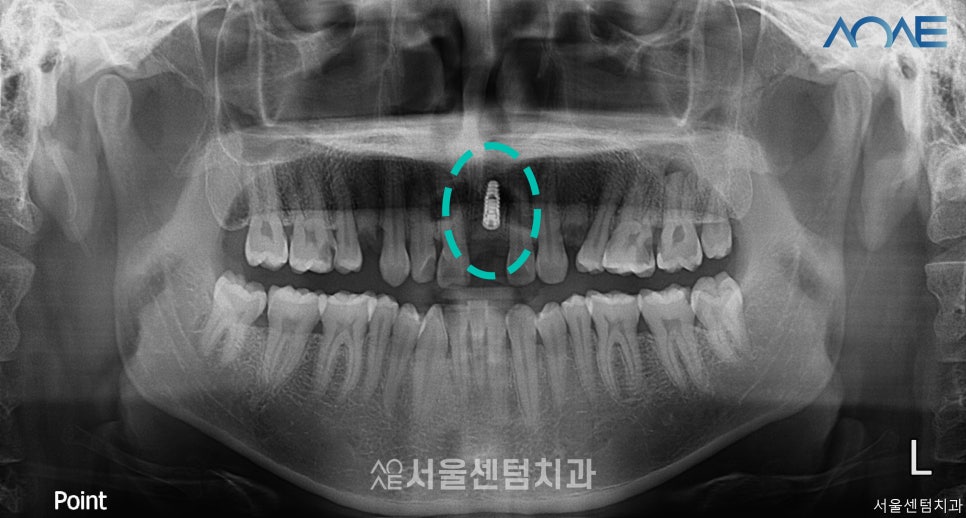당일임플란트 상담부터 풀과정 공개 관련 이미지 4