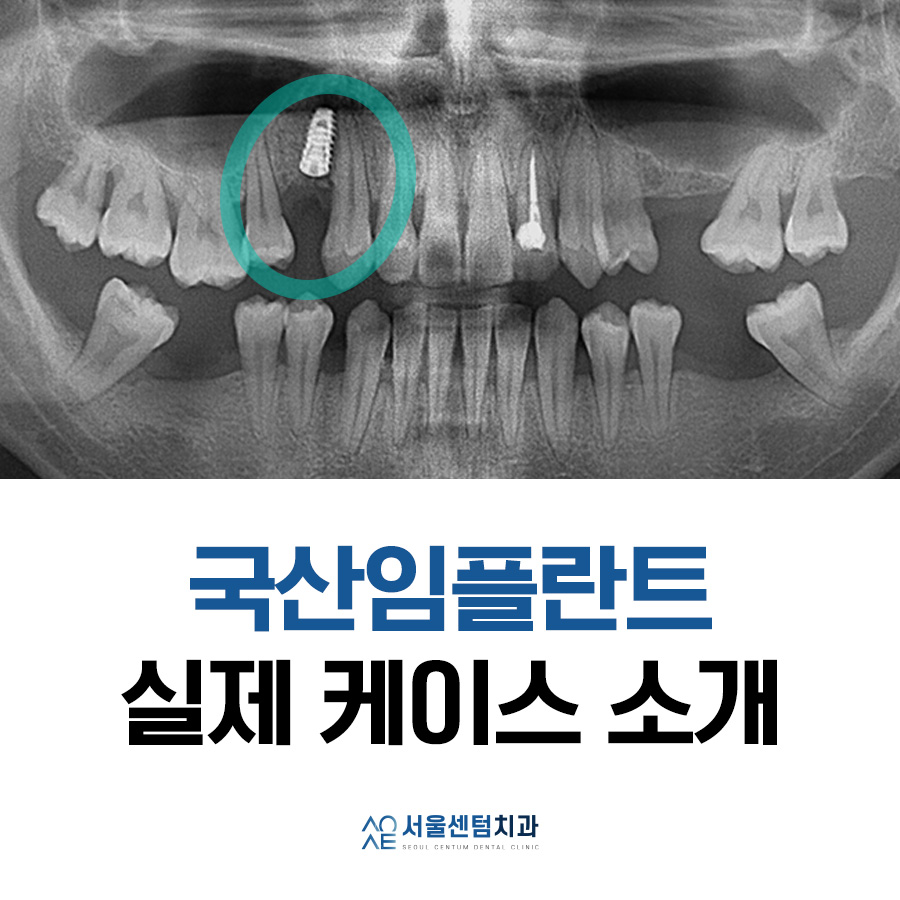 Here’s How a Korean-Made Implant Is Actually Placed image 7