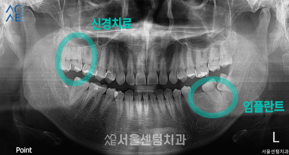 치아 신경치료 단계 임플란트까지 고려한다면 관련 이미지 1