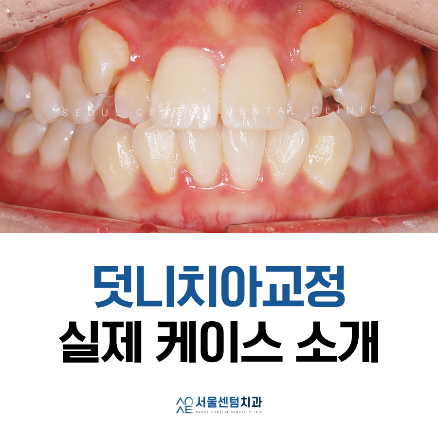 Explaining Orthodontic Treatment for Snaggletooth with Real Photos image 4