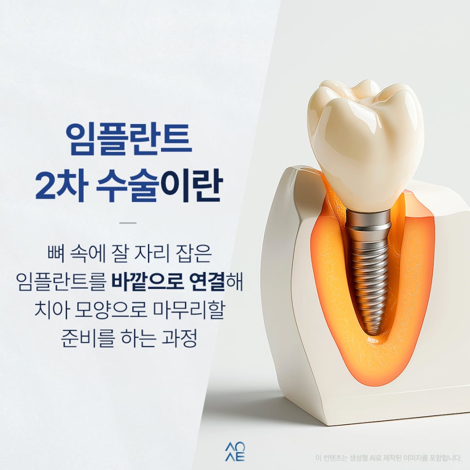 임플란트 2차 수술 후기 생각보다 안 아팠다는 말이 많은 이유 관련 이미지 2