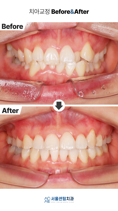 클리피씨 교정 이러한 경우라면 추천 관련 이미지 4