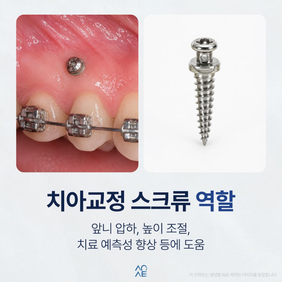 Are Orthodontic Screws Necessary for Correcting an Overbite? They Look Painful image 3