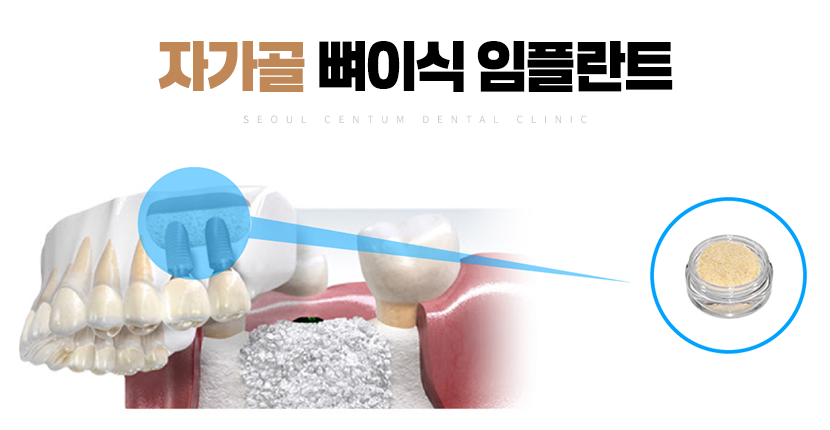 치아 뼈이식 비용 얼마로 산정될까? 관련 이미지 6
