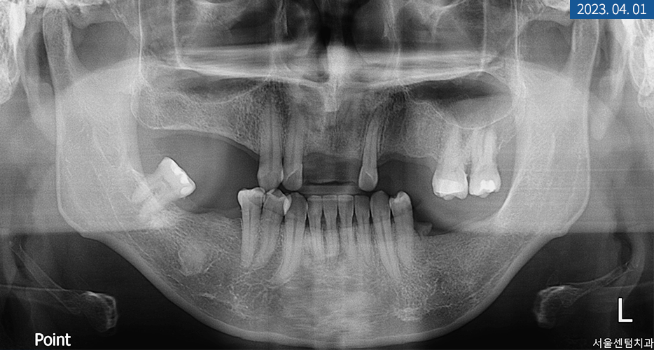 임플란트 브릿지와 크라운 수복으로 치아 기능을 회복시킨 증례 관련 이미지 3