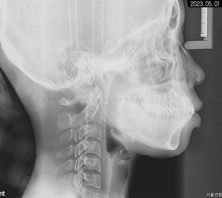 비발치로 돌출입 해소한 증례 관련 이미지 3