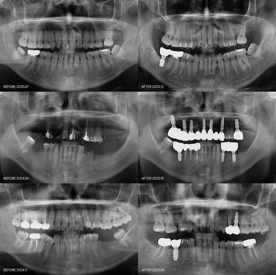 발치 후에 들어가는 임플란트 시기 어떤 기준으로 결정이? 관련 이미지 6