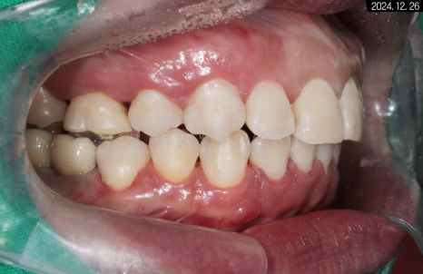 돌출입 및 신경치료와 임플란트 식립 동시 진행 증례 관련 이미지 28