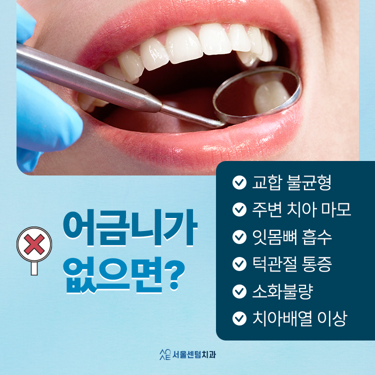어금니 임플란트 앞니보다 신중해야 한다? 숨은 진실 관련 이미지 2
