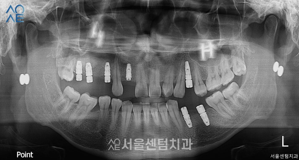 임플란트 과정 기간 실제 사례로 설명드려요 관련 이미지 5