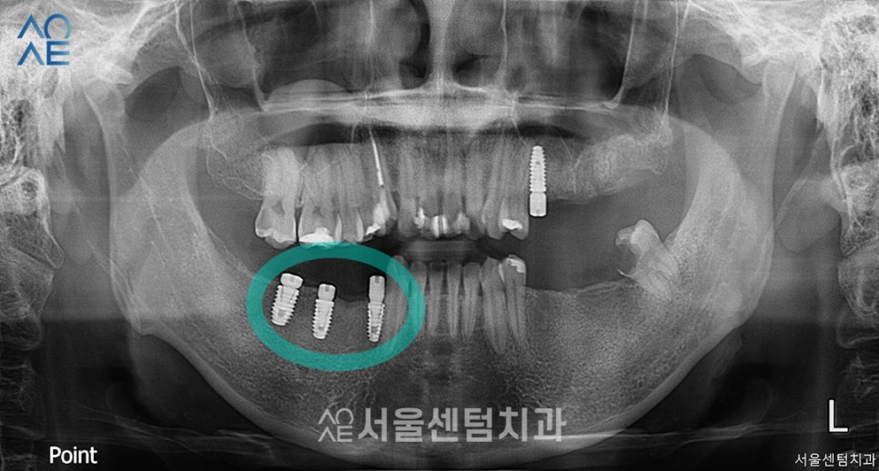30대임플란트 치아상태 좋지 않아도 안심 관련 이미지 3