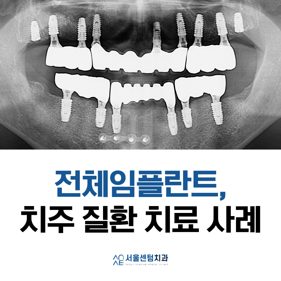 전체임플란트 기간 예상보다 줄어들 수 있는 방법과 증례 공개 관련 이미지 1