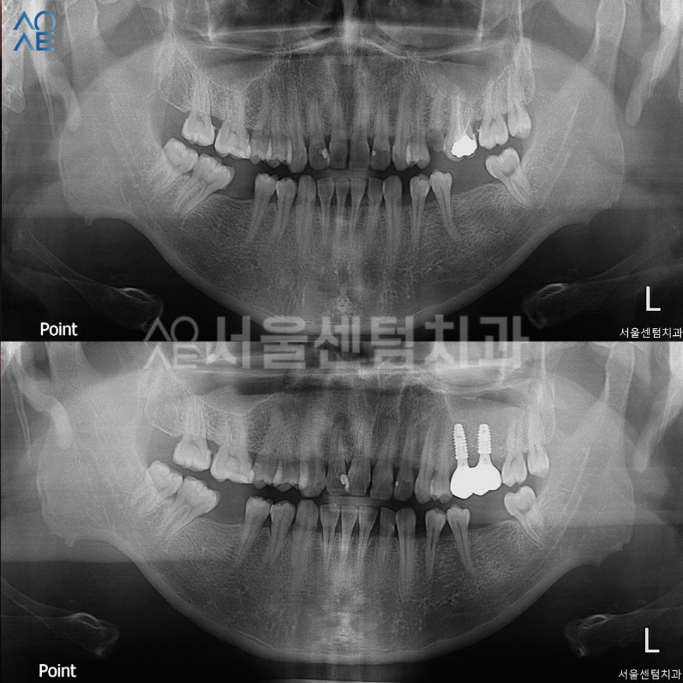 상악동수술 동반한 임플란트 진행한 이야기 관련 이미지 6