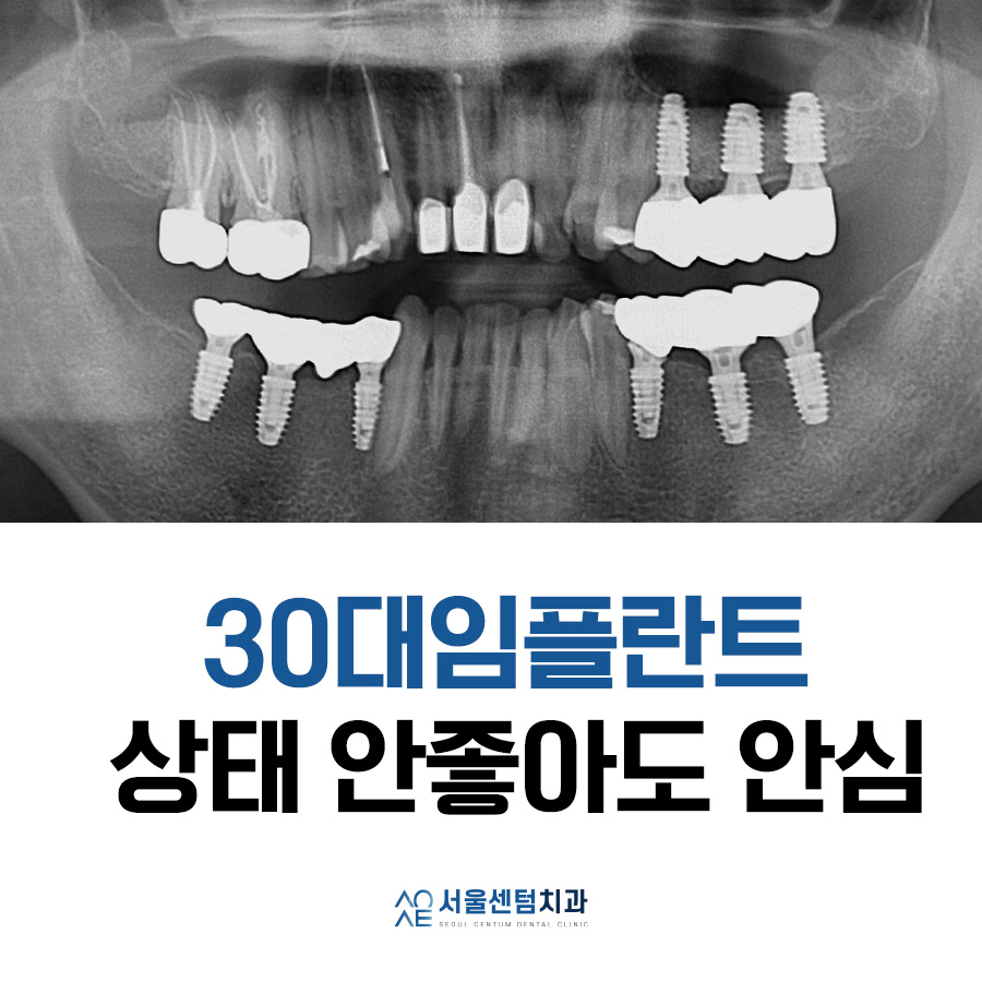30대임플란트 치아상태 좋지 않아도 안심 관련 이미지 9
