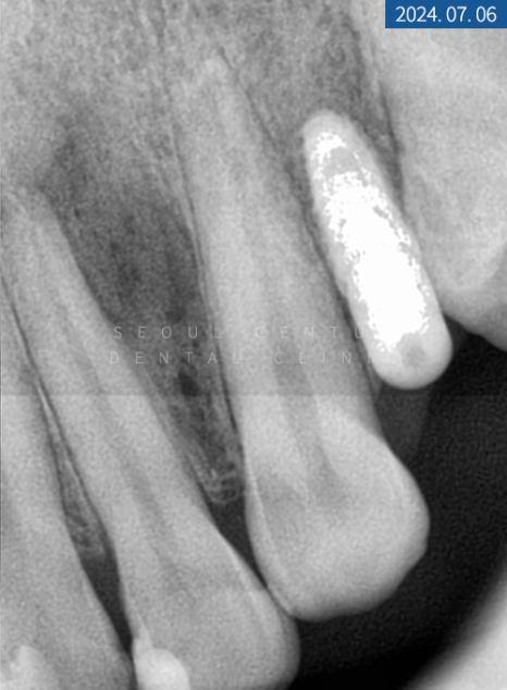 뼈이식 임플란트와 라미네이트 수복 증례 소개 관련 이미지 11