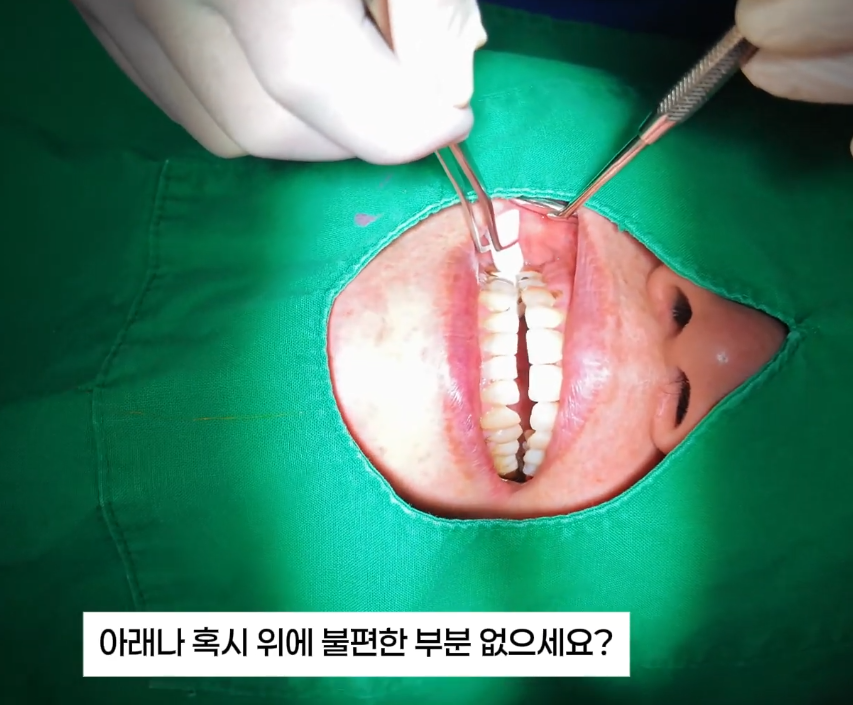 치아패임 이대로 두어도 괜찮을까요 치경부마모증 레진치료 관련 이미지 7