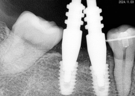 돌출입 및 신경치료와 임플란트 식립 동시 진행 증례 관련 이미지 22