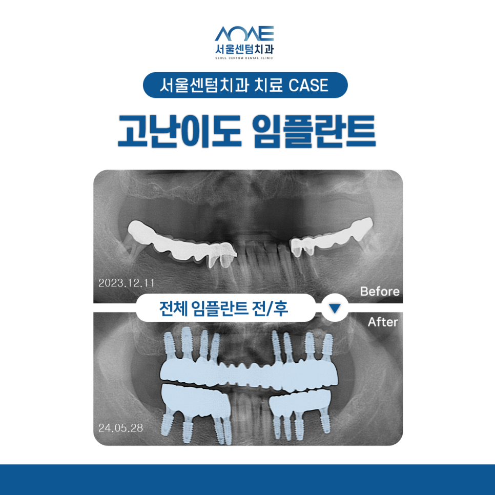 전체임플란트 노인틀니 보험 실비 비용 관련 이미지 11