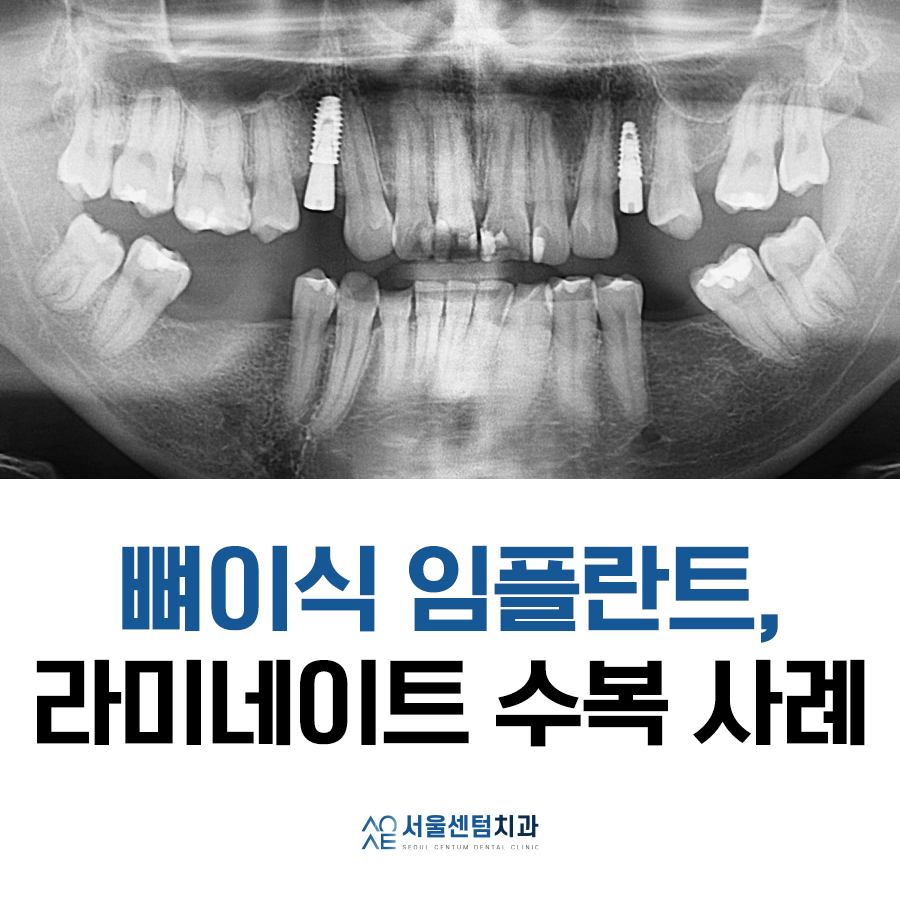 뼈이식 임플란트와 라미네이트 수복 증례 소개 관련 이미지 1
