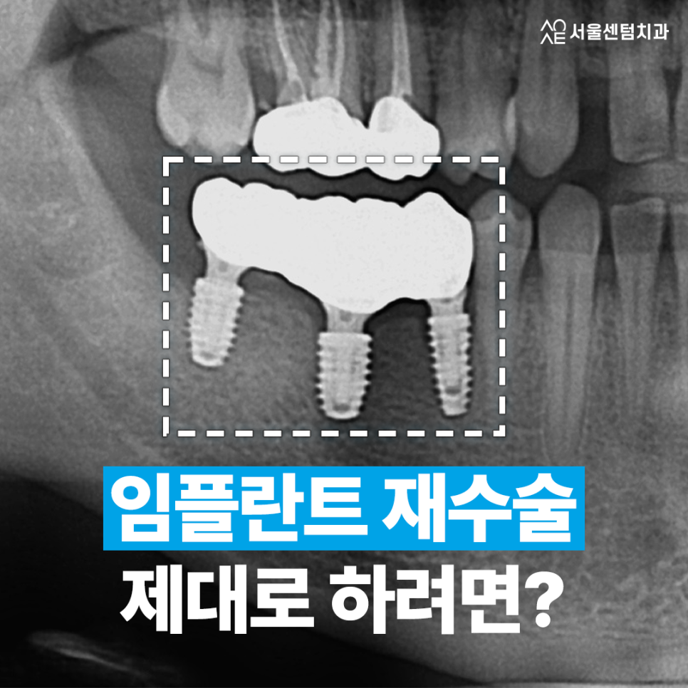 임플란트재수술 꼭 해야하는 경우는? 관련 이미지 1