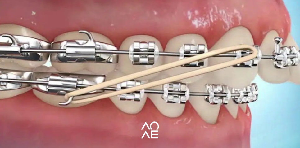 강남치아교정잘하는 교정 고무줄 통증 주의사항 관련 이미지 5