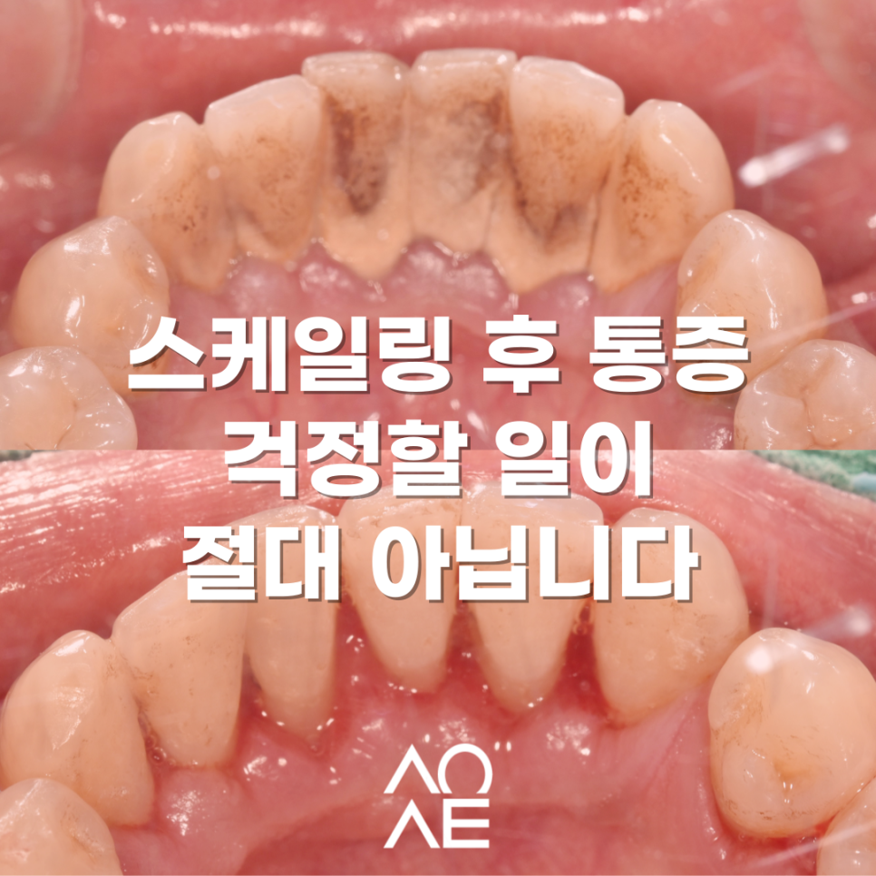 잠원동 스케일링 후 통증 당연히 있을 수 있습니다. 관련 이미지 9
