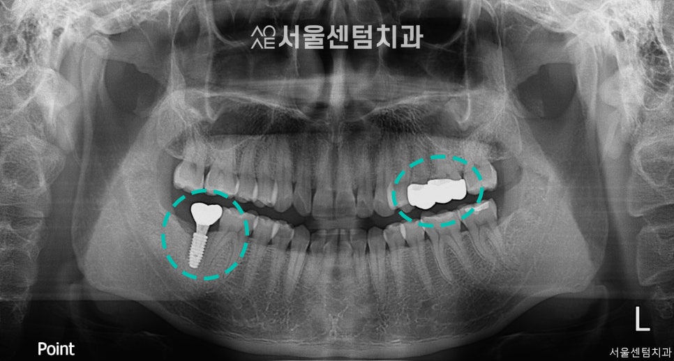 A Successful Molar Implant Case in a Patient in Their 20s image 8