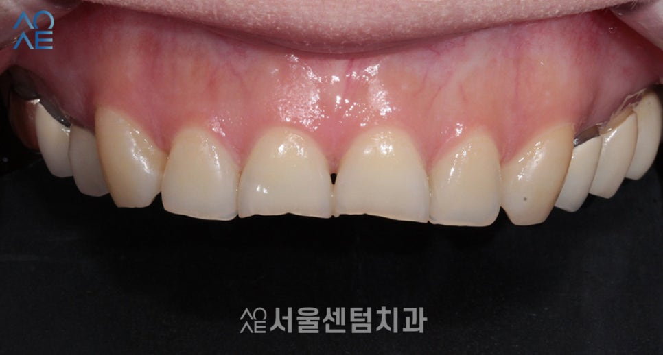 라미네이트 앞니 깨짐과 마모 해소한 증례 살펴보기 관련 이미지 1