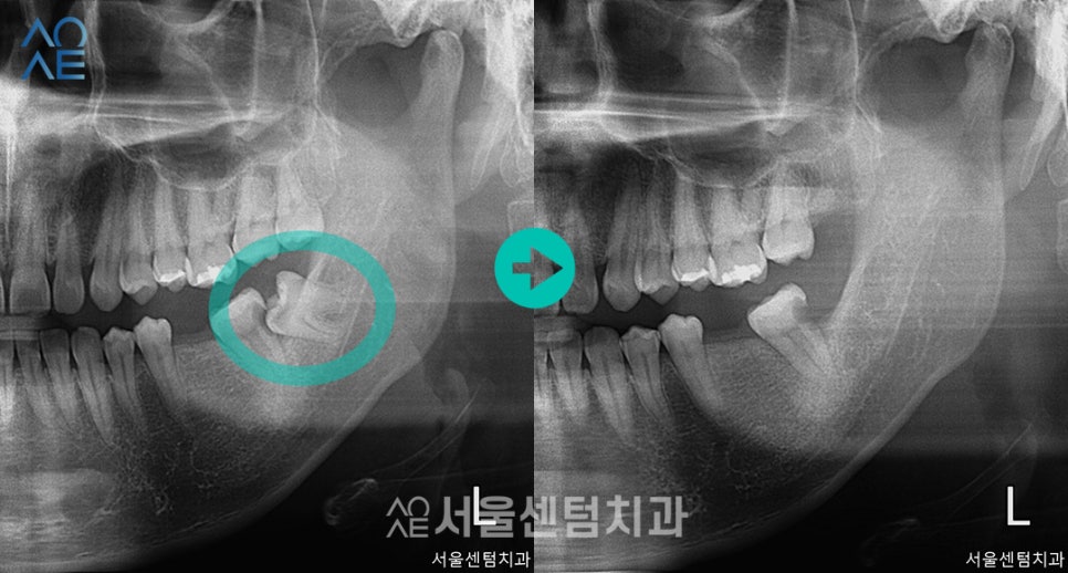 치아 신경치료 단계 임플란트까지 고려한다면 관련 이미지 3