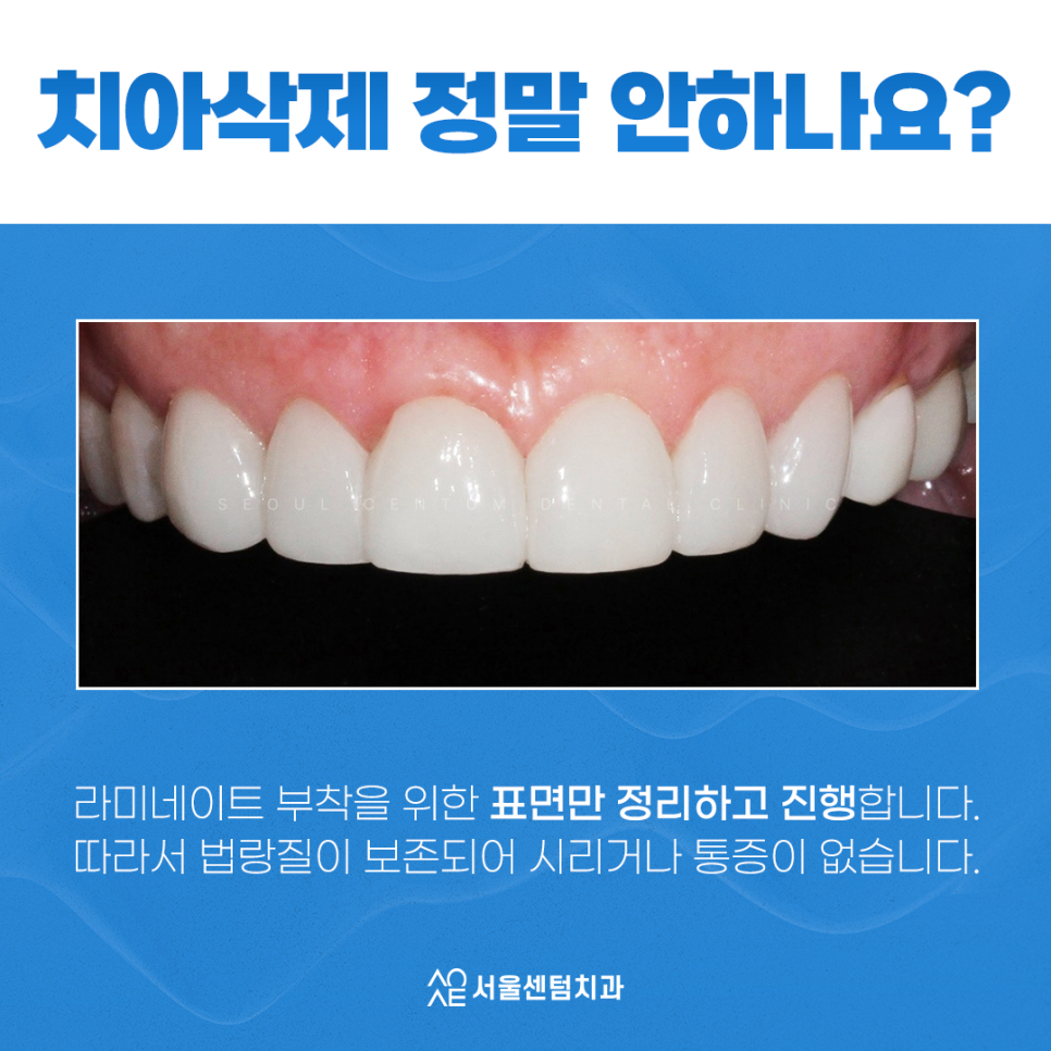 무삭제 라미네이트 안되는 분들도 많습니다. 관련 이미지 4