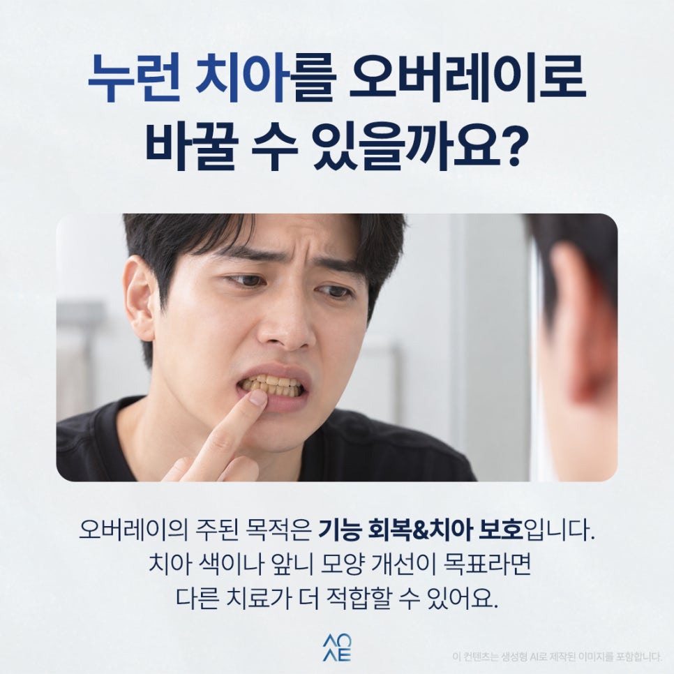 오버레이 크라운 치아를 얼마나 깎나요 심미 목적으로 해도 될지 궁금해요 관련 이미지 4