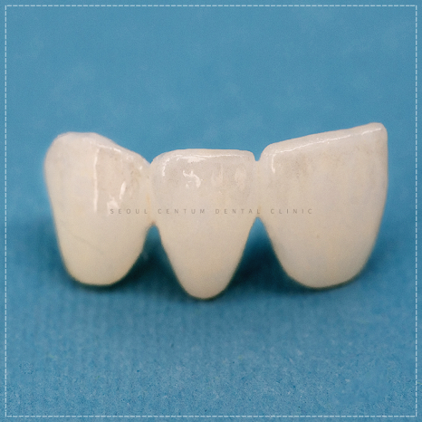 치아브릿지가격 종류에 따른 안내와 장단점 설명 관련 이미지 6