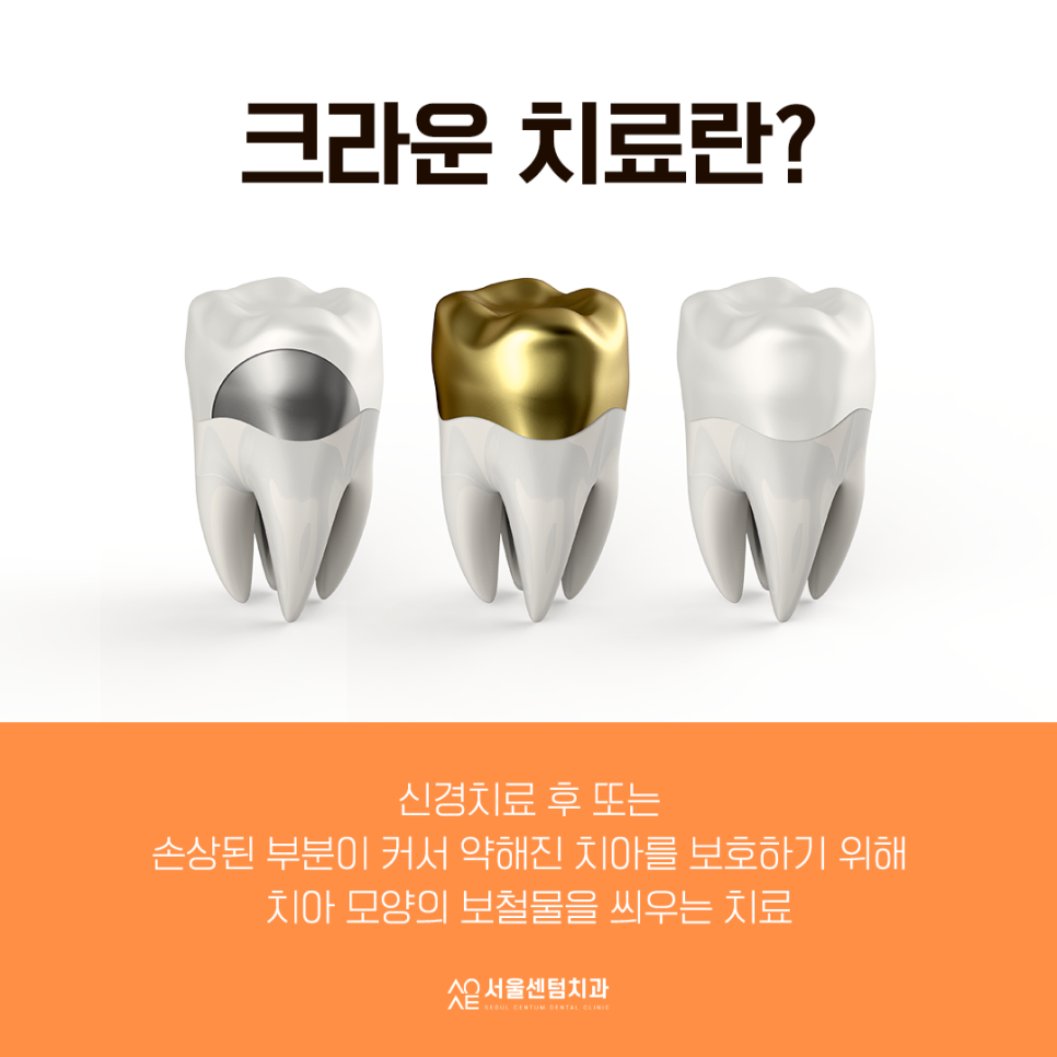치과 크라운 종류 선택 쉽도록 설명할게요 관련 이미지 2