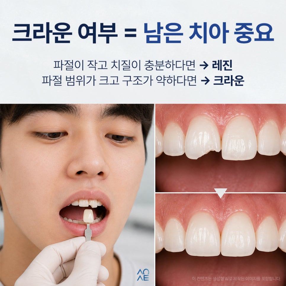 앞니파절 후 신경치료 크라운 잠간고정술 무조건 필요한가요? 관련 이미지 4