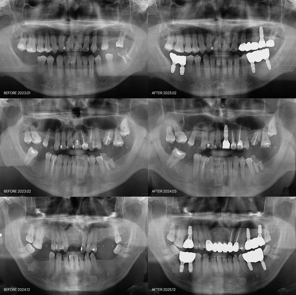 군인이 치아 파절되면 제대하고 오스템 임플란트 시 비용 무료일까? 관련 이미지 6