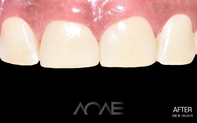 잠원동치과 무삭제 라미네이트 기간 앞니 깨짐 관련 이미지 5