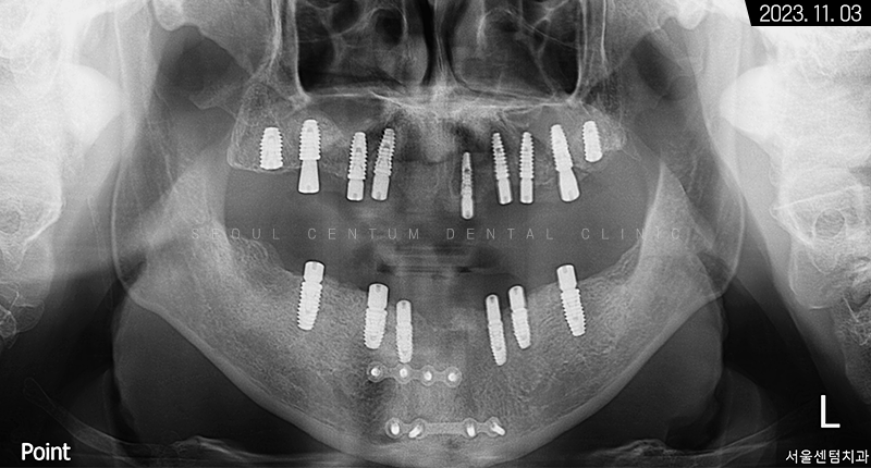 전체임플란트 기간 예상보다 줄어들 수 있는 방법과 증례 공개 관련 이미지 11