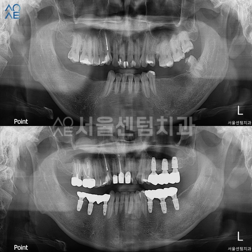 30대임플란트 치아상태 좋지 않아도 안심 관련 이미지 8