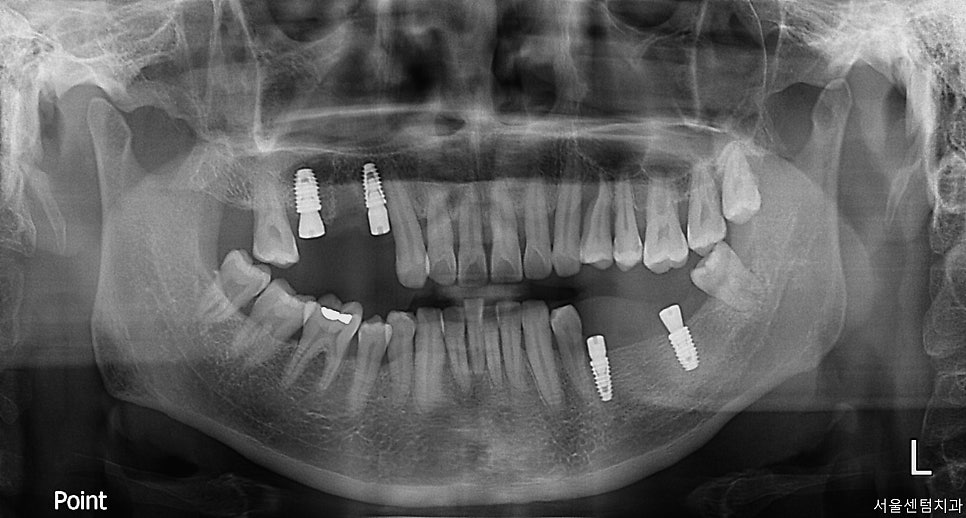 임플란트 순서 어금니부터 앞니부터 어디부터 해야할까요 관련 이미지 5