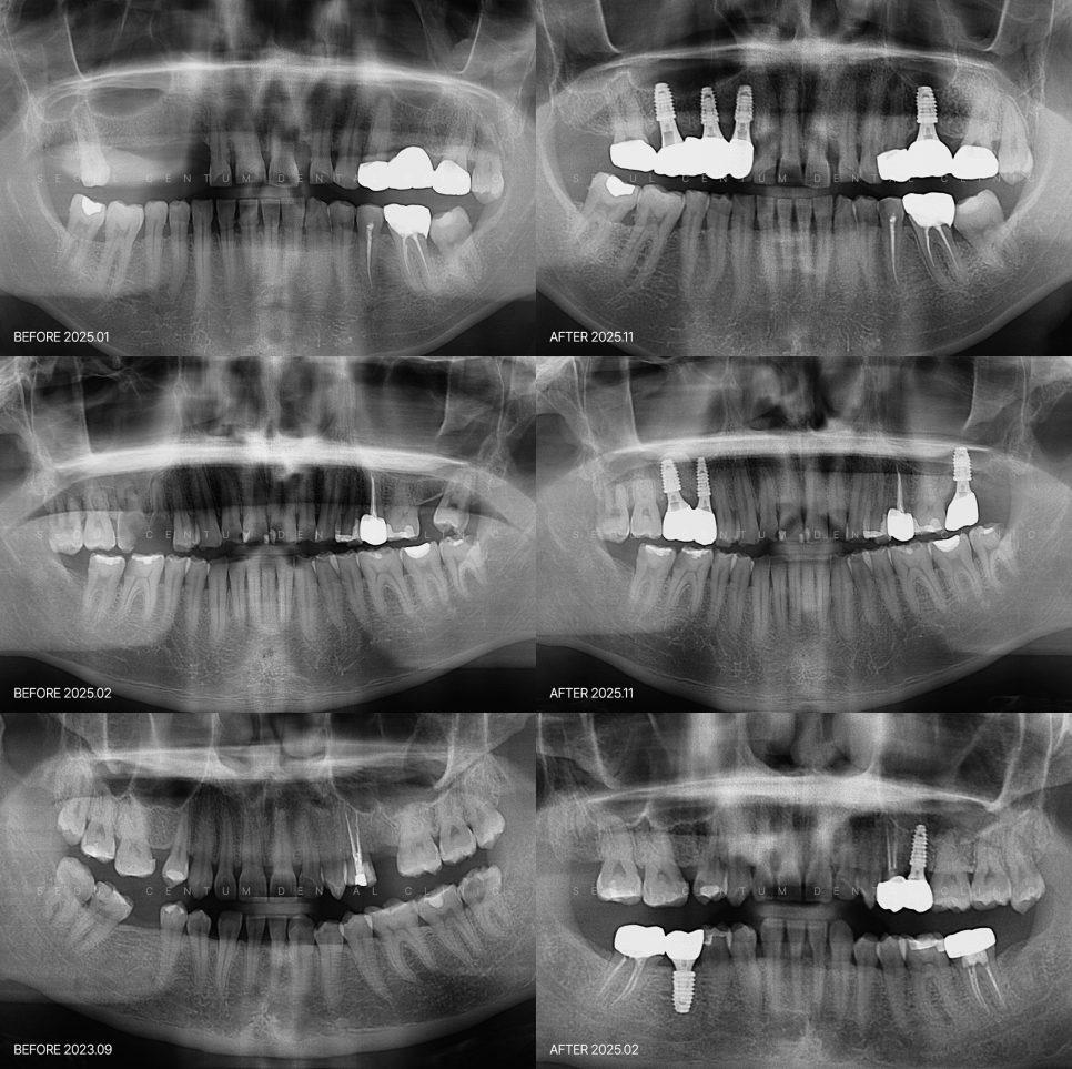 임플란트 할 때의 절차 과정은 대체로 이렇게 진행돼요 관련 이미지 6