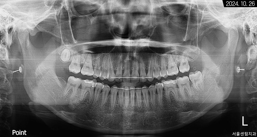 비발치로 돌출입 해소한 증례 관련 이미지 9