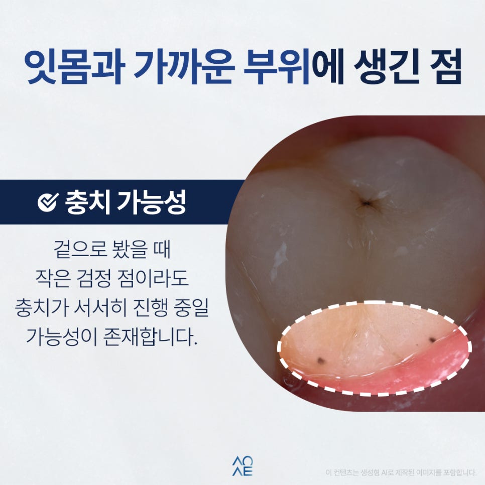 치아 검은점 발견했다면 충치인지 다른 문제인지 구분 방법 관련 이미지 3