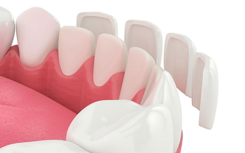 잠원동치과 무삭제 라미네이트 기간 앞니 깨짐 관련 이미지 11