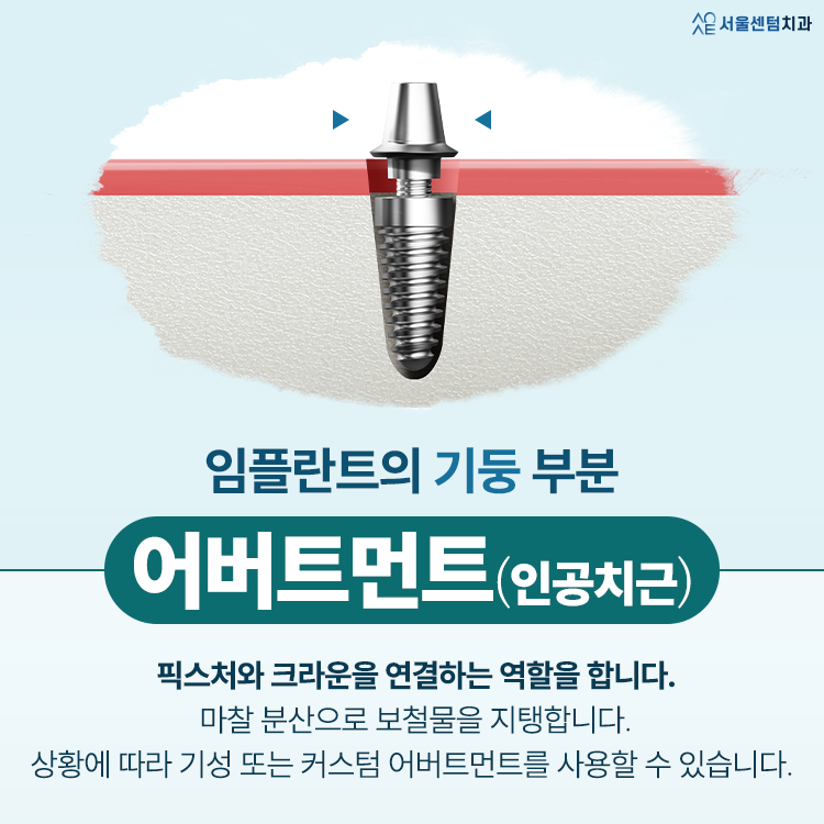 임플란트 구조 하나하나 뜯어보면 알 수 있는 원리 관련 이미지 4