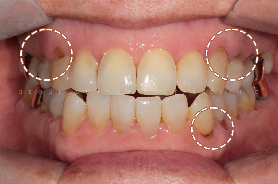 치경부마모증 가격 gi 레진 갈색치아 원인 통증 관련 이미지 8