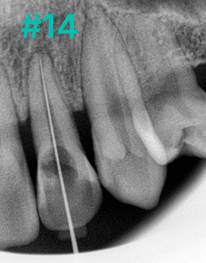 Here’s How a Korean-Made Implant Is Actually Placed image 2