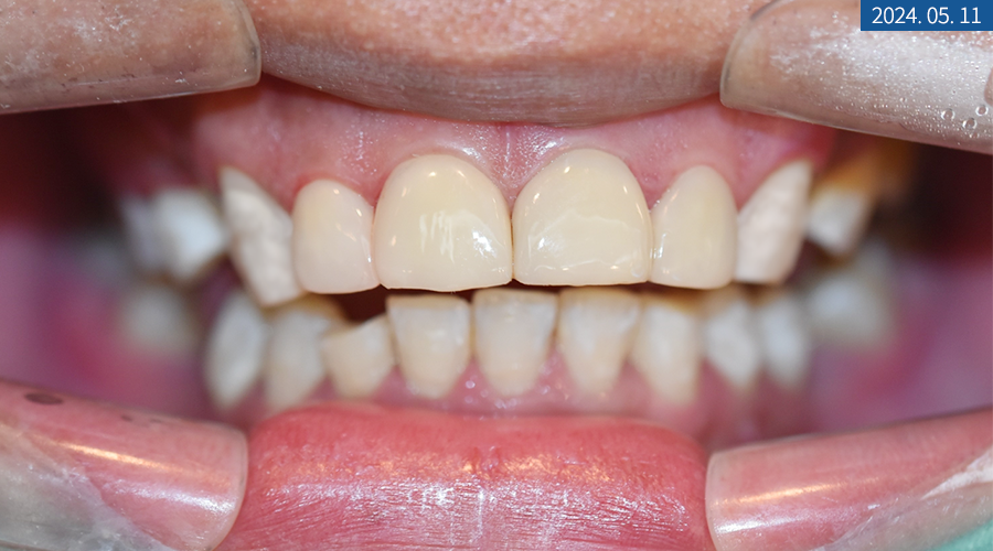 뼈이식 임플란트와 라미네이트 수복 증례 소개 관련 이미지 10
